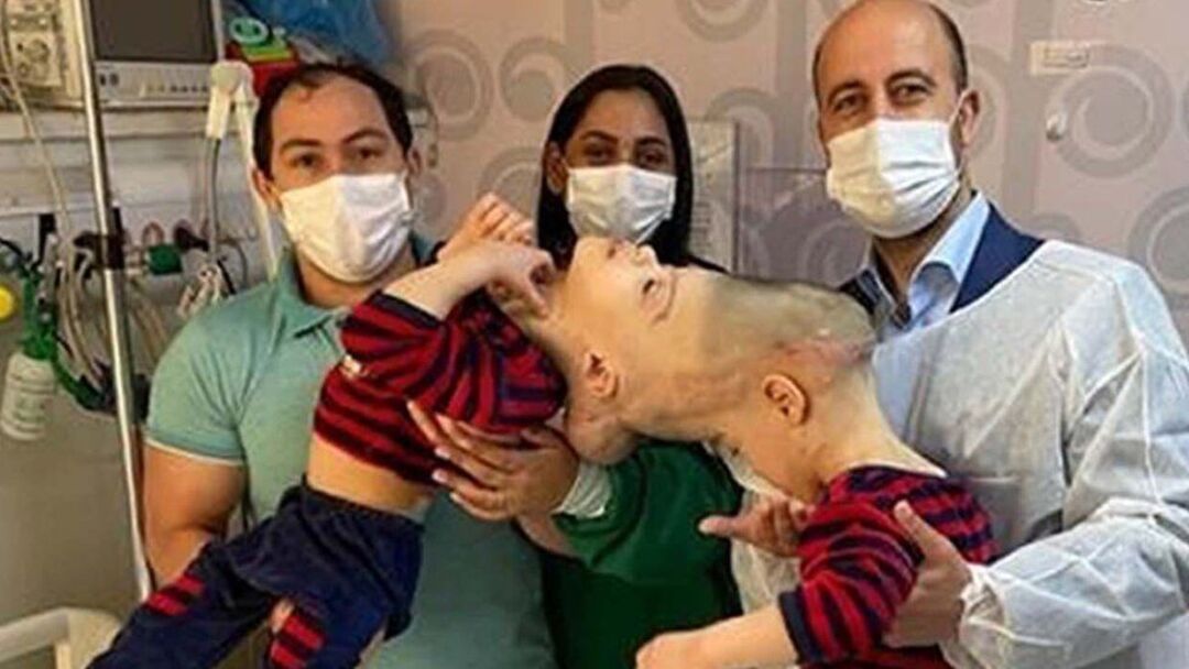 Conjoined twins separated with the help of virtual reality