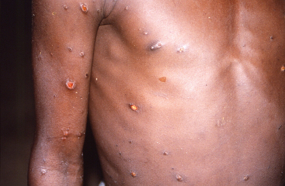 WHO declares monkeypox a global health emergency