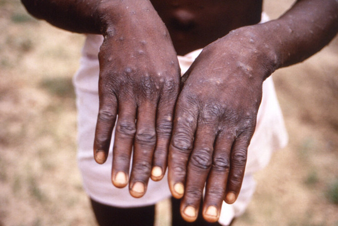 EU approves smallpox vaccine for use against monkeypox