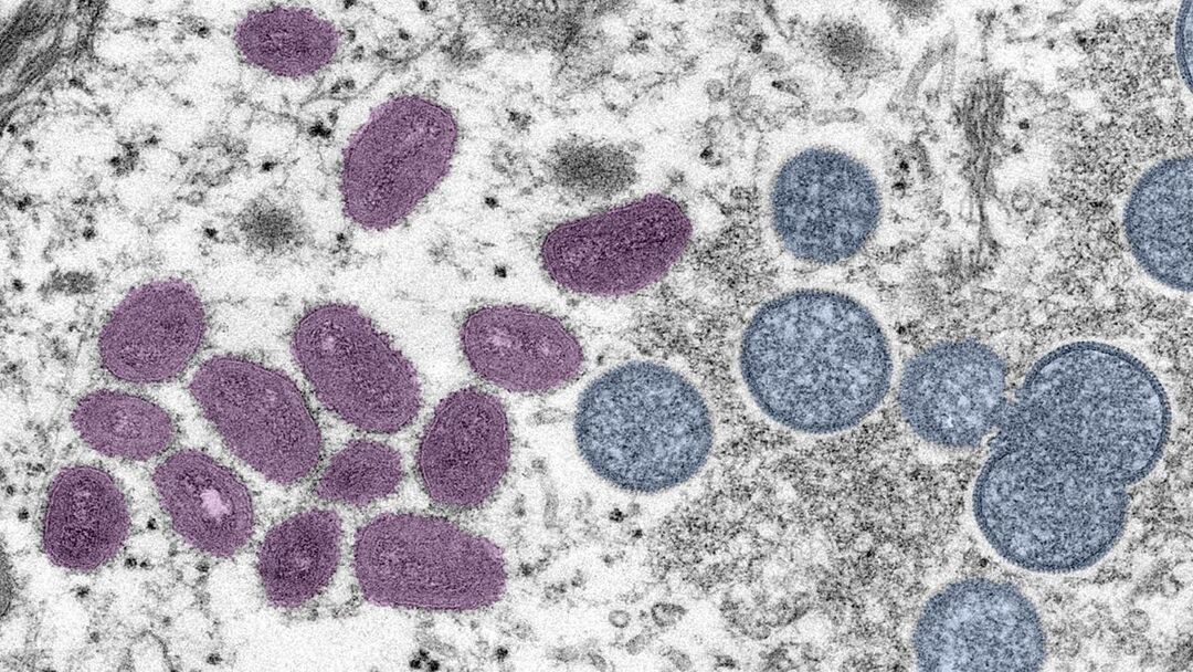 CDC: More than 700 monkeypox cases globally including 21 in US